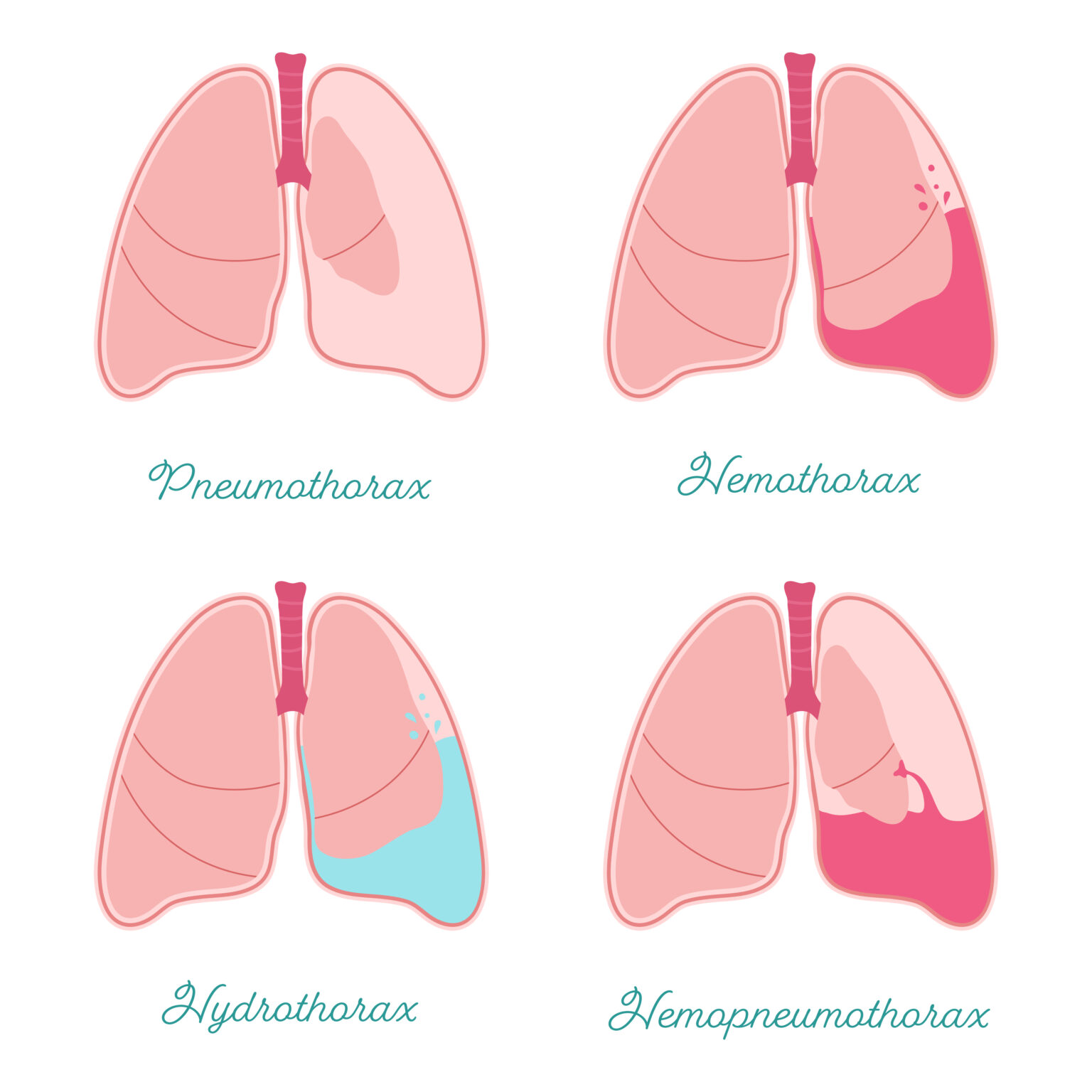 Parietal Pleura And Serous Membranes: A Complete Overview - m6l9alv